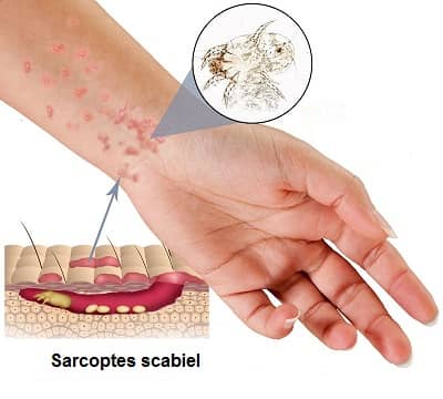 Ακάρεα Ψώρας